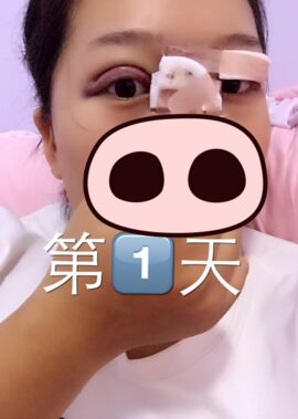 終于把雙眼皮割了，無錫菲尚張樹功做的