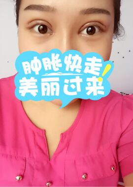 終于把雙眼皮割了，無錫菲尚張樹功做的