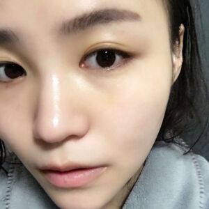 埋埋蛋白線.提升后臉上變得緊致許多，輪廓變得更好看