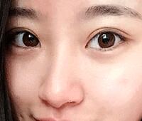 內(nèi)切去眼袋價(jià)格2180元，祛眼袋前后對(duì)比圖分享給大家