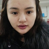 玻尿酸隆鼻花了兩萬多果很自然哦，值~！