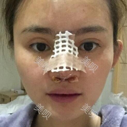 玻尿酸隆鼻花了兩萬多果很自然哦，值~！