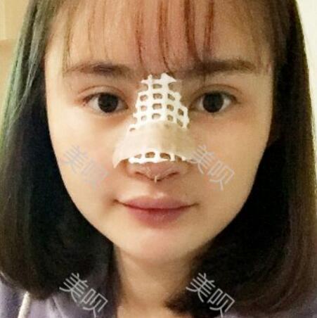 玻尿酸隆鼻花了兩萬多果很自然哦，值~！