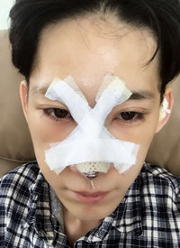 深圳廣和尹衛(wèi)民做的隆鼻整形，大家來看看果
