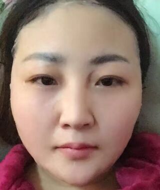 金子甘國端醫(yī)生給我做完高強(qiáng)度聚焦超聲之后皮膚緊致多了