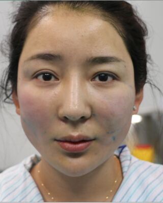 埋埋蛋白線.提升整個面部年輕很多，小V臉也出來了