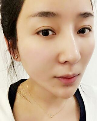 埋埋蛋白線.提升整個面部年輕很多，小V臉也出來了