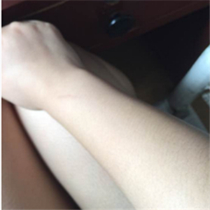 注射美白k氧注射針五次了，看看我的術(shù)后恢復(fù)果圖片吧~