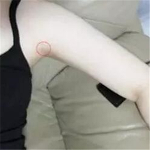 做了吸脂瘦手臂四個月，果很自然，有恢復(fù)前后對比果圖片哦~
