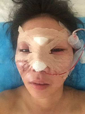 隆鼻手術(shù)前后過程對(duì)比圖，真實(shí)案例分享