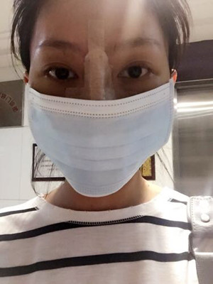 隆鼻手術(shù)前后過程對(duì)比圖，真實(shí)案例分享