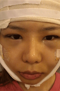 磨骨+下巴矯正手術(shù)前后過程(膽小勿入!)真實(shí)案例分享