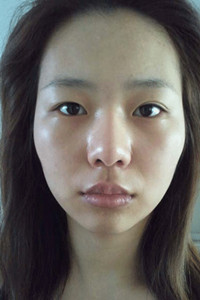 磨骨+下巴矯正手術(shù)前后過程(膽小勿入!)真實(shí)案例分享