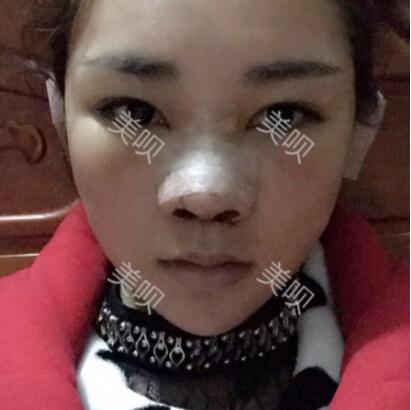 給大家分享在長(zhǎng)沙鵬愛(ài)做的膨體隆鼻近一個(gè)月的恢復(fù)過(guò)程