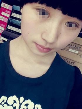 做了切開雙眼皮手術(shù)，現(xiàn)在恢復(fù)的還不錯(cuò)哦