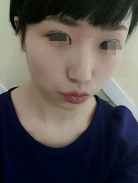 做了切開雙眼皮手術(shù)，現(xiàn)在恢復(fù)的還不錯(cuò)哦