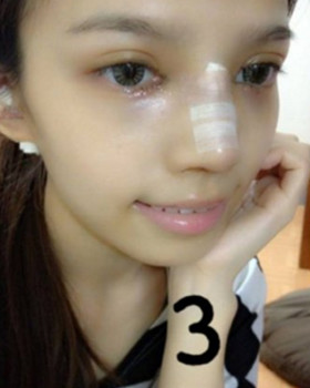 記錄了隆鼻三個(gè)月前后的恢復(fù)過程，希望可以幫到有需要的朋友