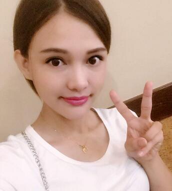 玻尿酸豐太陽(yáng)7天果圖 愛(ài)悅麗格豐太陽(yáng)穴一個(gè)月啦~