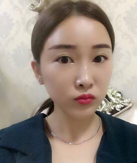 愛(ài)悅麗格玻尿酸豐蘋(píng)果肌、豐下巴、隆鼻