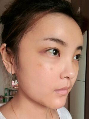 自體脂肪面部填充之后飽滿又自然，廣州曙光劉永波做噠