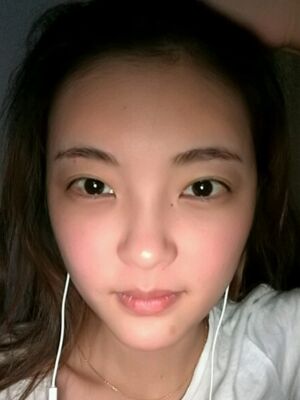 自體脂肪面部填充之后飽滿又自然，廣州曙光劉永波做噠