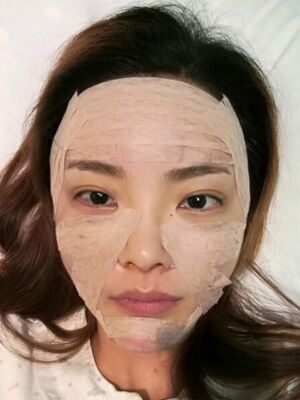 自體脂肪面部填充之后飽滿又自然，廣州曙光劉永波做噠