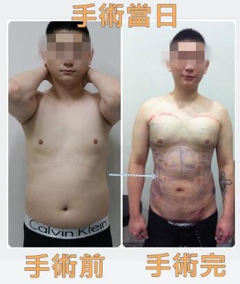 吸脂減肥前后對(duì)比圖