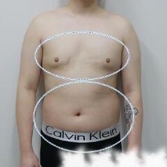 吸脂減肥手術(shù)瘦身，也算一個(gè)正能量胖子逆襲的故事吧