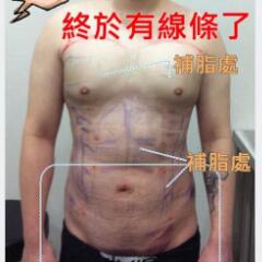 吸脂減肥手術(shù)瘦身，也算一個(gè)正能量胖子逆襲的故事吧