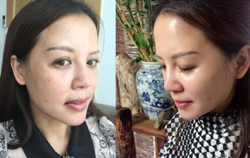 蛋白埋埋蛋白線.提升手術前后對比照片