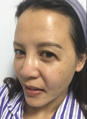 蛋白埋埋蛋白線.提升手術前照片