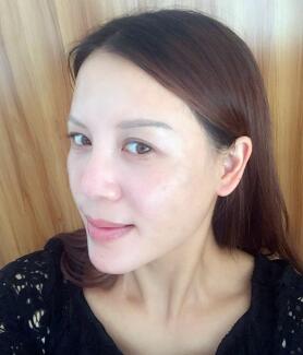 蛋白埋埋蛋白線.提升手術前后對比照片,術后第(一)天