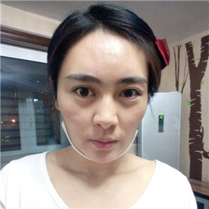 光纖溶脂去雙下巴臉型更好看了