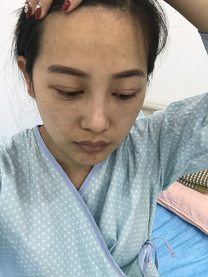 自體脂肪隆眉弓后，更有精神了