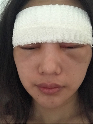 自體脂肪隆眉弓后，更有精神了