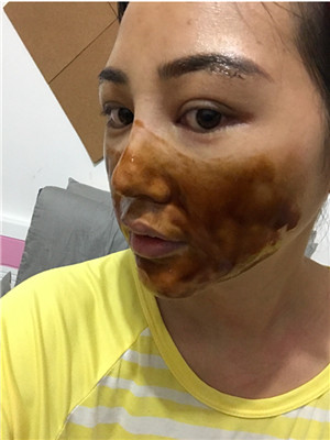 自體脂肪隆眉弓后，更有精神了