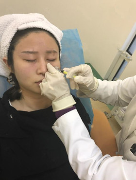 記錄了玻尿酸填充淚溝手術(shù)前后過程，還有前后對比圖哦