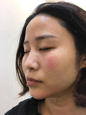 記錄了玻尿酸填充淚溝手術(shù)前后過程，還有前后對比圖哦