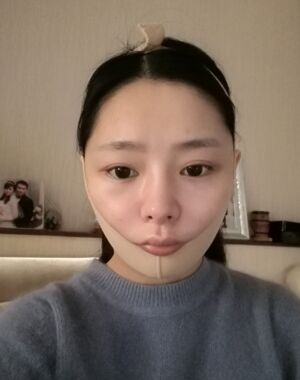 廣州曙光劉永波做的雙下巴吸脂后臉型好看多了