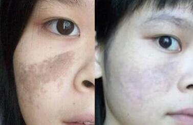 激光去胎記前后對(duì)比圖