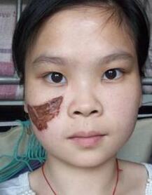 激光去胎記,去大田痣