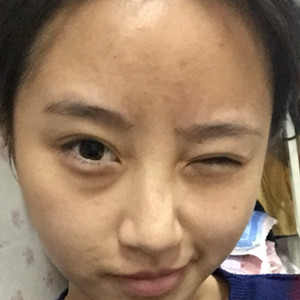 做了玻尿酸隆眉弓，感覺棒棒噠