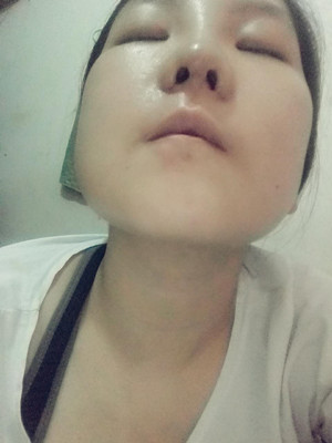 做了隆鼻整形手術(shù)，給大家分享一下手術(shù)過程，還有對比照片哦