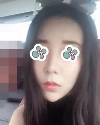 隆鼻失敗修復(fù)后整給鼻形很精致，鄭志敏醫(yī)生做的
