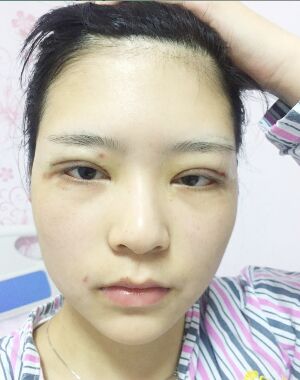 全切雙眼皮修復后恢復成漂亮的眼睛了