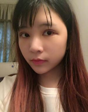 全切雙眼皮修復后恢復成漂亮的眼睛了