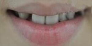 做了美容冠矯正 現(xiàn)在我的牙齒整齊又漂亮