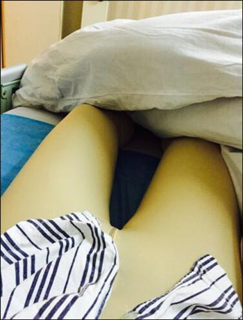 大腿吸脂手術(shù)真的是解決很難減下去的良藥 看我得果就知道