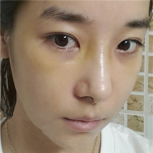 廣州博仕做了隆鼻整形半年了，分享恢復(fù)過(guò)程和前后對(duì)比果照片哦~