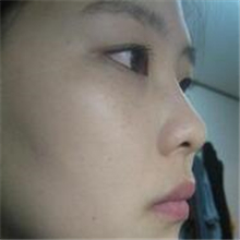 分享我的雙眼皮+開內(nèi)眼角+切除鼻中隔軟骨整形手術(shù)恢復(fù)經(jīng)歷~
